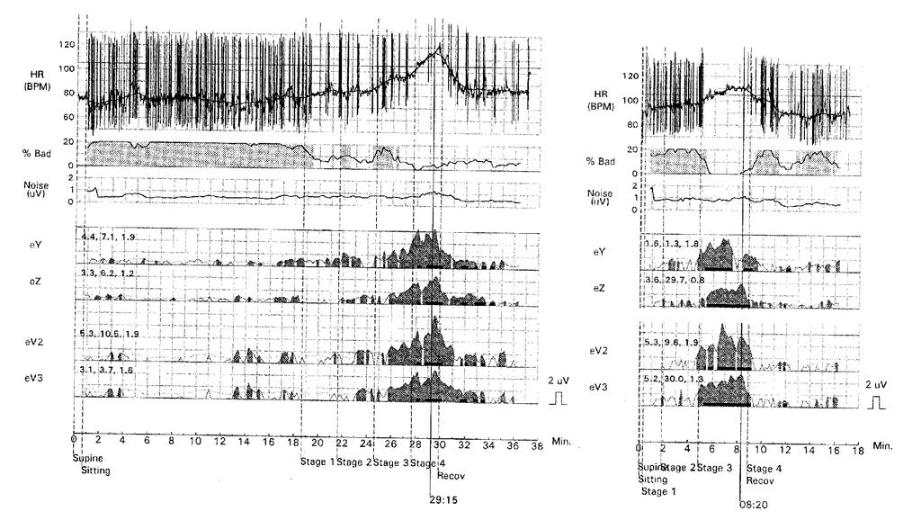 REPRODUCIBILITY OF T WAVE ALTERNANS Table II.