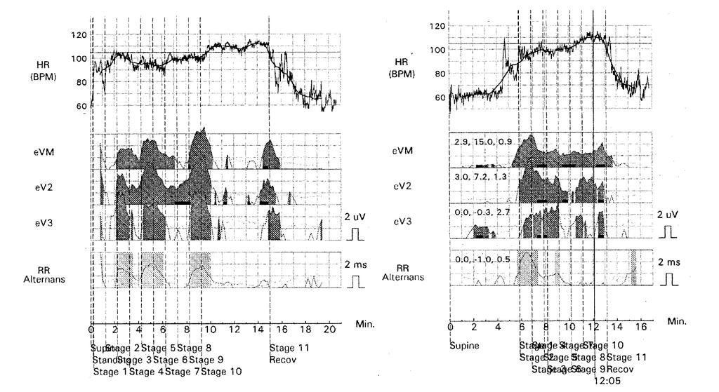 BLOOMFIELD, ET AL. Figure 4. T wave alternans tests are shown for the first test (left panel) and the second test (right panel).