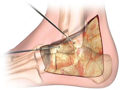 Incision The lateral aspect of the calcaneus is exposed through an extensile, full-thickness L or J - shaped incision.