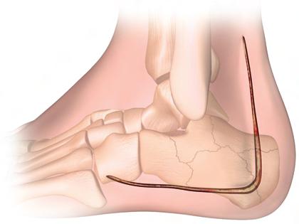 Continue the incision parallel with the tendon down towards the posterior/inferior aspect of the calcaneus.