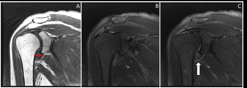 Fig. 1: Coronal Proton density (A) and fat saturated T2WI (B and C) MR images of the right shoulder from a patient with chronic pain and decreasing range of motion.