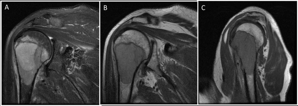 Fig. 5: Coronal fat saturated T2WI (A) proton density (B) and sagittal proton density (C) MR images of the left shoulder of a patient with a history of prostate cancer with pain.