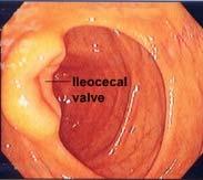 Ileocecal Valve Open: Backflow of large intestine contents into small intestine Closed: Lack of progression from small intestine into large intestine Gastroileal reflex causes valve to open