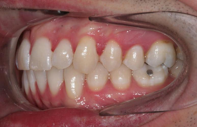 Occlusal INTRA-ORAL COLOUR