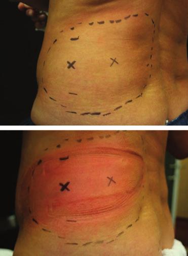 D IERICKX E T A L post-treatment photographs. Caliper measurements were taken at the treatment site and a control site. The control site was selected from a region not receiving treatment (e.g., if flanks were treated, the control site was the abdomen).