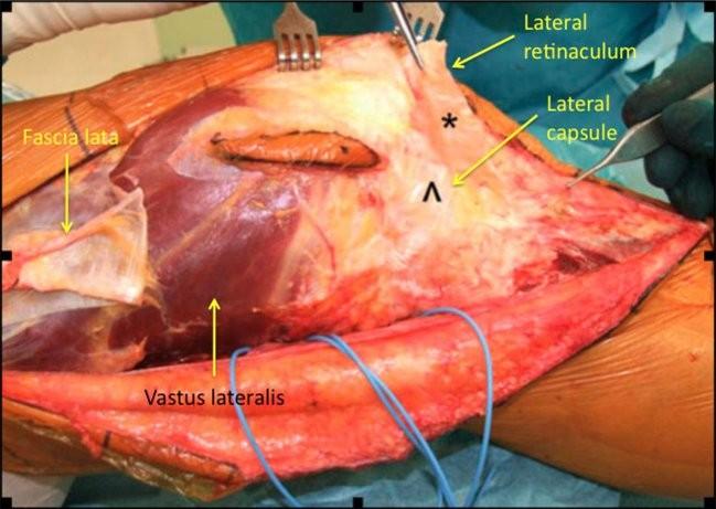 Figure 10: Lateral retinaculum disection and fascia lata elevation from Gerdy's tubercle Lateral collateral ligament is detached from femoral insertion, popliteus tendon and both cruciate ligaments