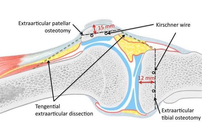 Figure 11: Patellar and tibial osteotomy.