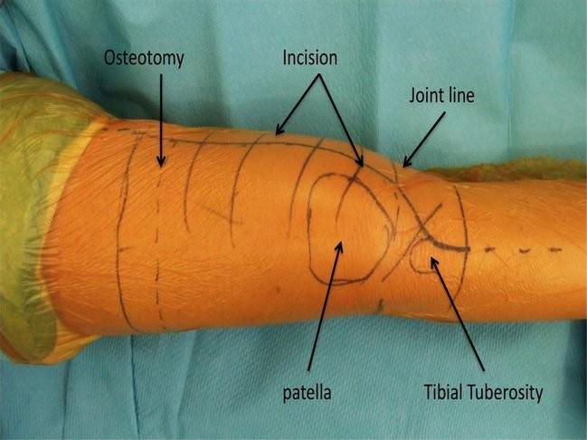 Figure 1: Skin landmarks Vessels dissection, Preparation of Hunter s Canal The first step includes the identification of the vessels.