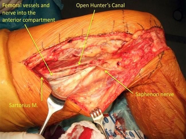 Figure 3: Deep to the sartorius muscle, superficial femoral vessels are