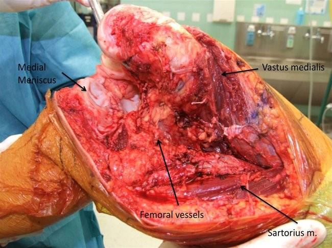 tendon and progresses proximally following femoral capsular insertion if tumor extension permits it. This type of opening provides a large medial capsular flap for prosthesis coverage.