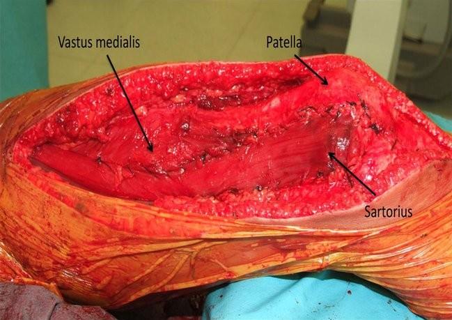 sacrifice some pedicles for muscle better mobilization. Innervation is from one or two branches of the femoral nerve that enters muscle undersurface proximally.