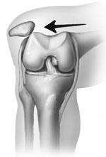 A dislocation occurs when the bones of the knee are out of place, either completely or partially.