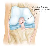 In people who have normal knee structure, dislocations are most often caused by high energy trauma, such as falls, motor vehicle crashes, and sportsrelated contact. Patellar dislocation.