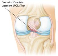 Posterior Cruciate Ligament Injuries The posterior cruciate ligament is often injured from a blow to the front of the knee while the knee is bent.