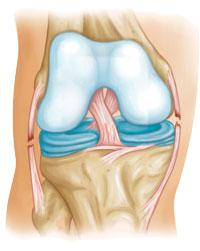 Posterior cruciate ligament tear (shown from back of knee). For more information about PCL injuries: Posterior Cruciate Ligament Injuries (topic.cfm?