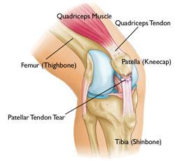 For more information about meniscal tears: Meniscus Tears (topic.cfm?topic=a00358) Tendon Tears The quadriceps and patellar tendons can be stretched and torn.