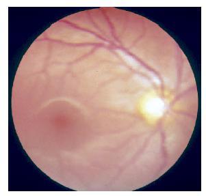 Special Parts of the Retina Fovea Centralis (yellow spot) An oval depression lateral to optic disc about 0.4 mm diameter Present in the centre of a small yellow pit (Macula Lutea; 4.