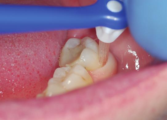 Although similar to the gentle clean you may have already had, this goes deeper under the gums to remove any hard or soft plaque and flush away bacteria,