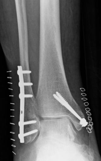 Risk Factors for Ankle Fractures Kuopio Osteoporosis Study During the 5 year follow-up, 11,798 women (aged 47-56 years) sustained 194 validated malleolar fractures, giving an incidence of 3.