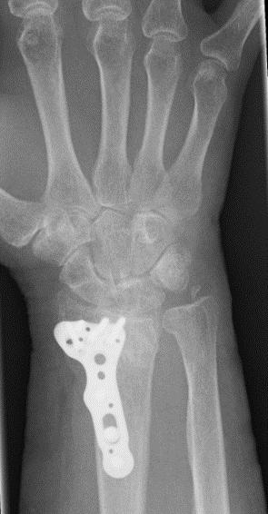 Risk Factors for Distal Forearm Fractures Kuopio Osteoporosis Study Independent predictors of DFF (Cox model) (11,798 women aged 47-56yr, 368 DFF in 5 yr fu) Increase of risk Decrease of risk *