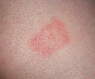 Lyme disease signs and symptoms Figure 5: Stages of Lyme disease: Lyme disease can persist for many years and infect a large number of organs.