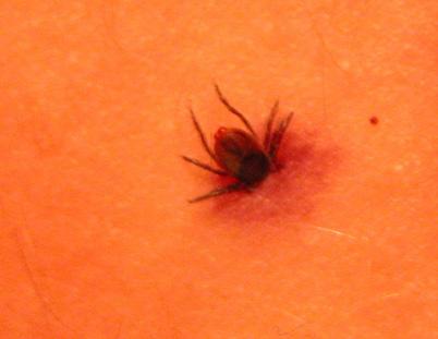 Checking your body for ticks after outdoors activities is a good habit, especially in areas where Lyme disease is prevalent.