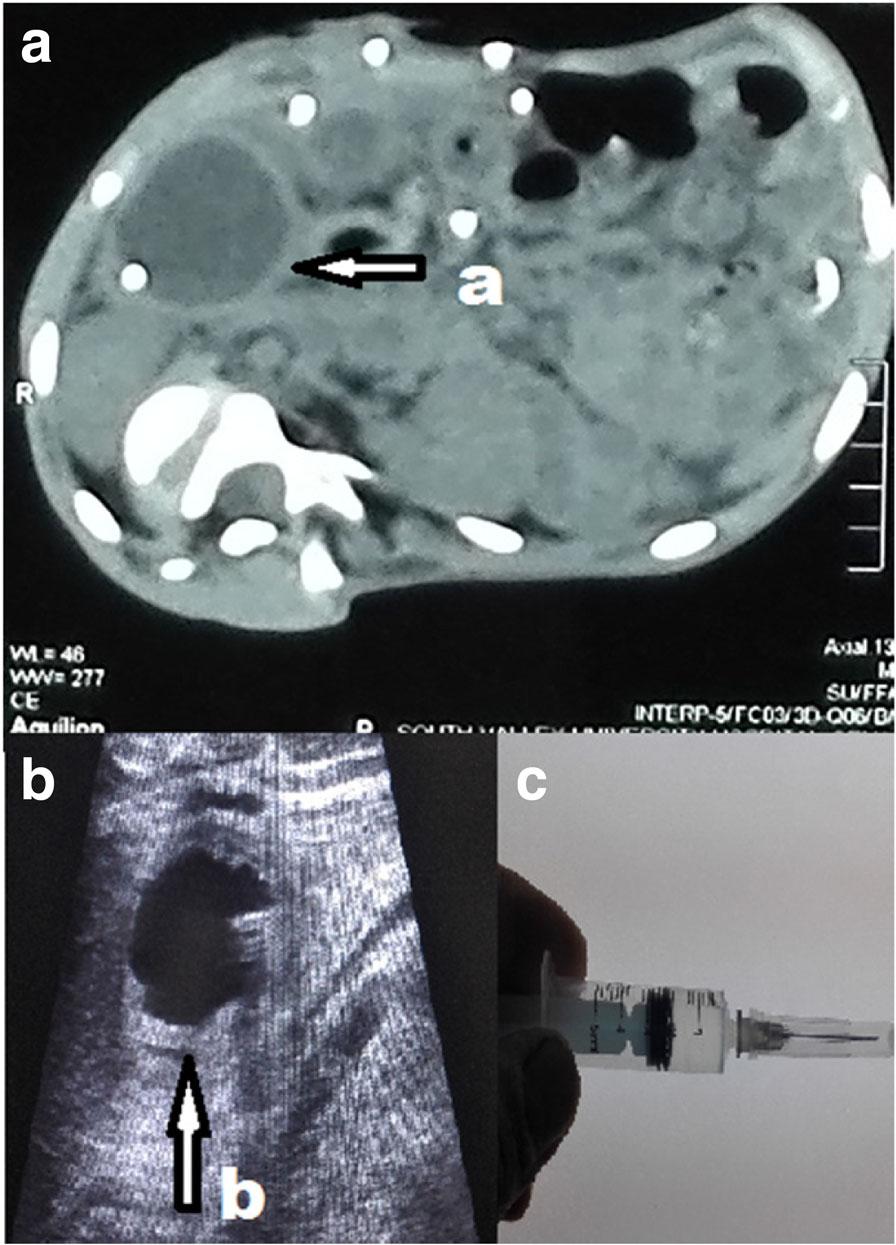 Hamdan Egyptian Journal of Neurosurgery (2019) 33:8 Page 6 of 8 Fig. 10 a CT abdomen axial view of a 13-year-old male patient showing right hypochondrial cyst (a arrow).