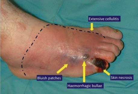Clinical Characteristics Suggesting a More Serious Diabetic Foot Infection (Table 3A) Systemic: