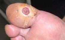 erythema 2 cm around ulcer, & infection