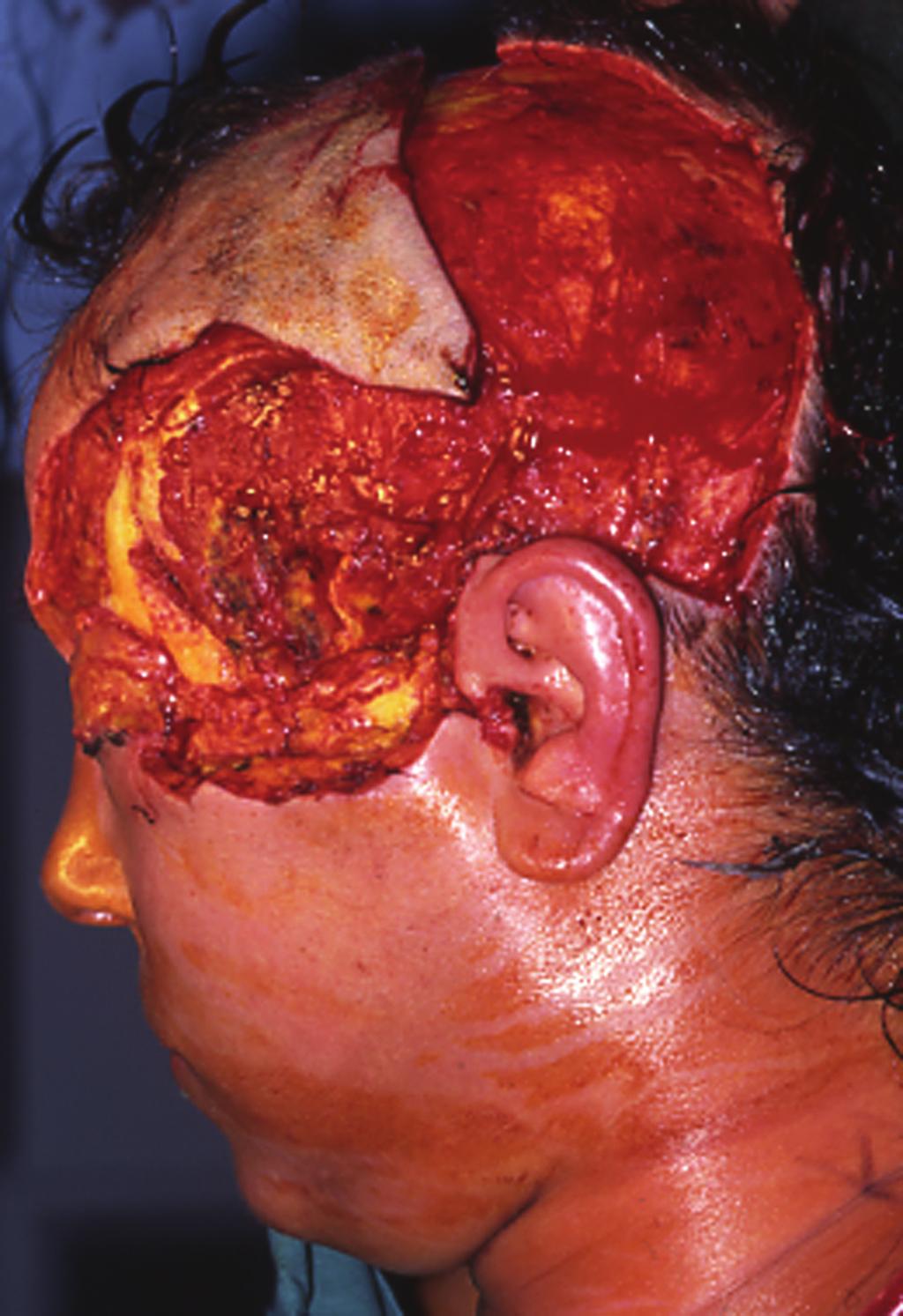 oedema. A large area of tissue had to be excised in order to arrest the progress of the infection.