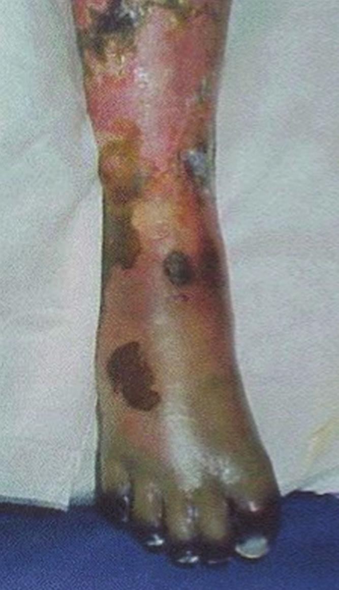 Clinical DIAGNOSIS In some patients, violaceous bullae can be noted on the skin surface, and these are often ﬁlled with foul smelling dish water pus.