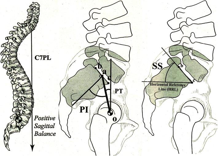 Spine Surg Relat Res 2017; 1(2): 56-60 Figure 2. Hole spine alignment. SVA: Sagittal vertical axis, PI: Pelvic incidence, PT: Pelvic tilt, SS: Sacral slope.