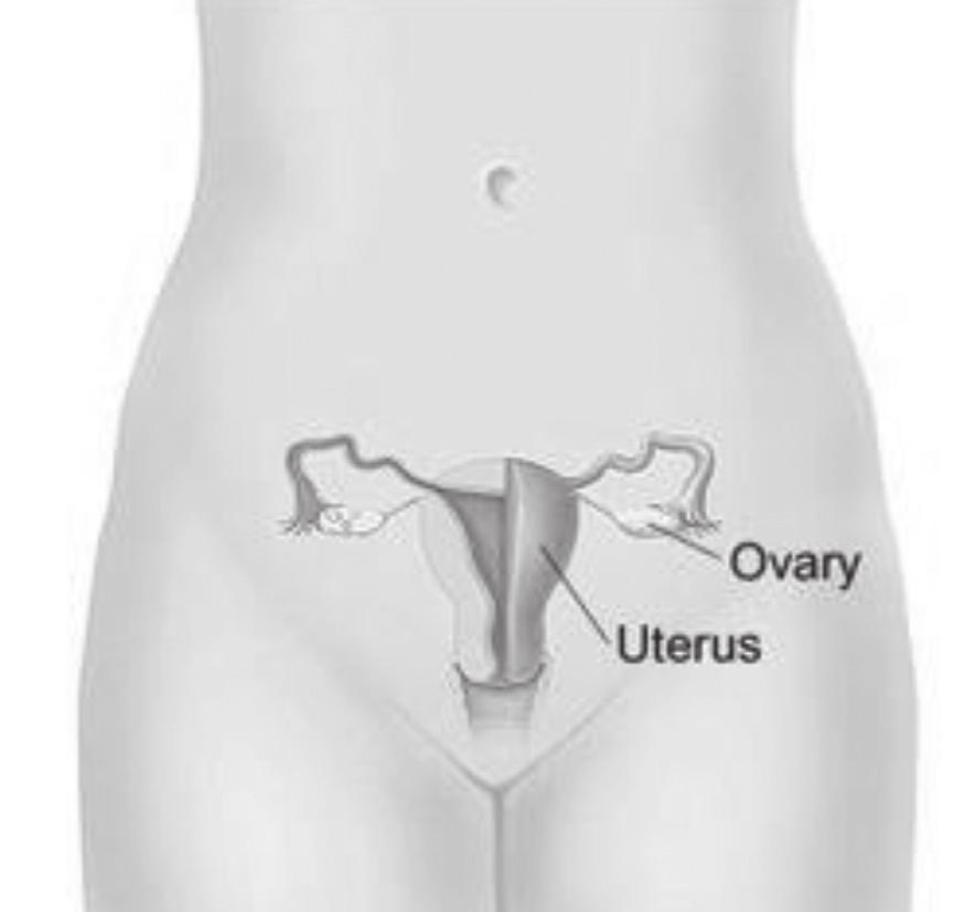 Overview Ovarian epithelial cancer, fallopian tube cancer, and primary peritoneal cancer are diseases in which malignant (cancer) cells form in the tissue covering the ovary or lining the fallopian