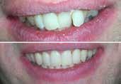 between two front teeth Treatment Duration: 11 months