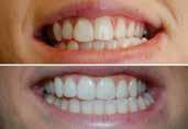 months Condition: Crooked Teeth Treatment Duration: