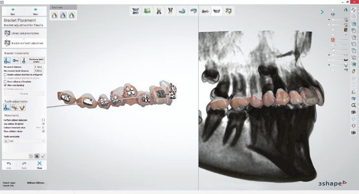 Offering more services to your patients and partners Take advantage of seamlessly integrated digital workflows with 3Shape X1 scans and 3Shape implant and orthodontic