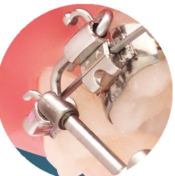 Springs Titanium Clamps & Screws ttachments Better Results with More Efficiency Help your non-compliant patients make the