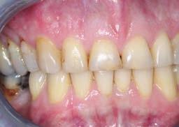 None of the upper or lower teeth had any periodontal or apical issues.