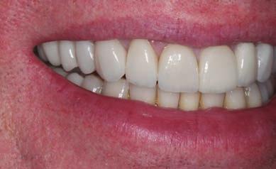 A composite Dahl appliance was placed on the upper left to upper right canine using the wax-up and a palatal step to allow axial loading on each tooth.