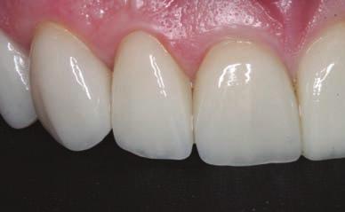 The temporary anterior restorations with the introduced canine guidance were photographed in a full-face photo and a rubber impression taken to allow the lab to fabricate an incisal guidance table.