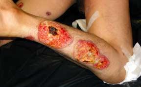 New lesions developed sequentially on the elbows, upper arms, shoulders, back, ears and scrotum.