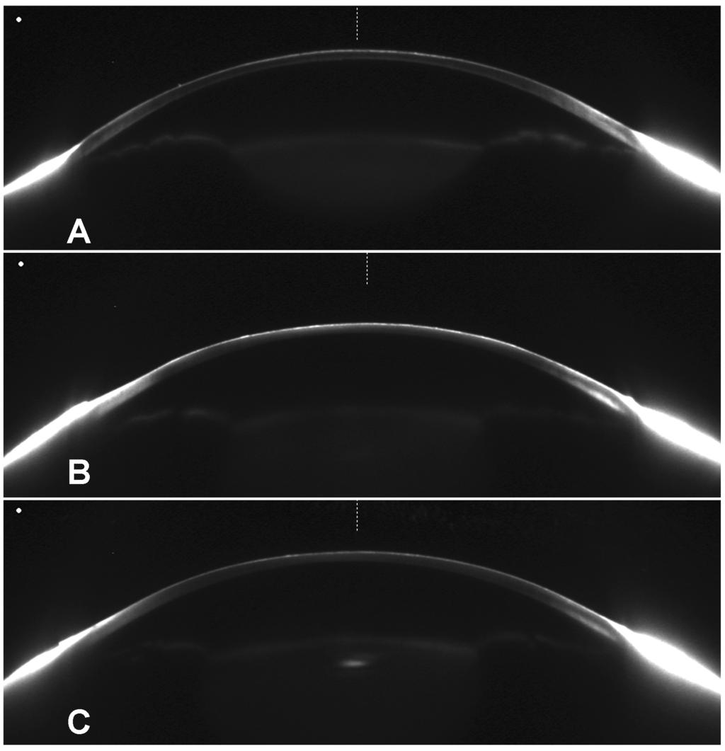 Densitometry 1 Scheimpflug images Results Average changes of corneal light backscattering, with respect to baseline
