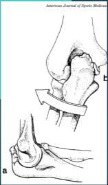 Valgus Extension Overload Valgus Extension Overload Large forces generated 64 N-mm valgus force 500 N compressive force Tensile force medially and shear stress in the posterior compartment Produces