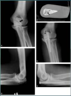 olecranon pain during and after throwing Tender along proximal ulna Radiographic evaluation Plain films often normal Bone scan MRI allows for evaluation of