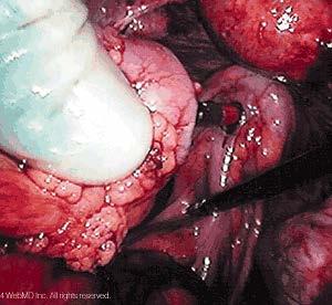 HAND-ASSISTED LAPAROSCOPIC RESECTION (Step 3-4) Exteriorization of Sigmoid Colon Once the colon is mobilized and the blood supply divided, it is