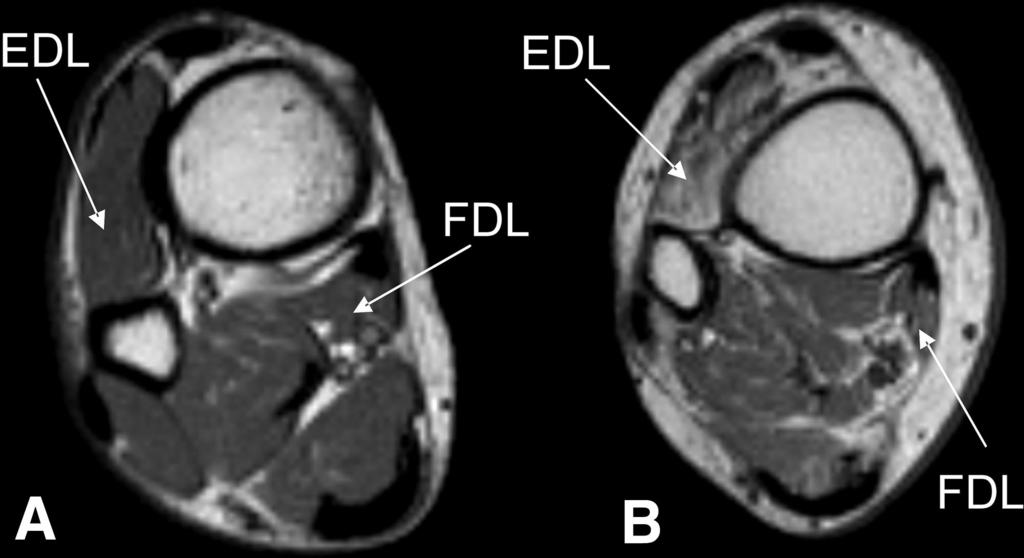 Bus and Associates Figure 1 Cross-sectional images of the distal lower leg in a healthy nondiabetic subject (A) and a neuropathic patient with severe atrophy of the EDL and mild atrophy of the FDL