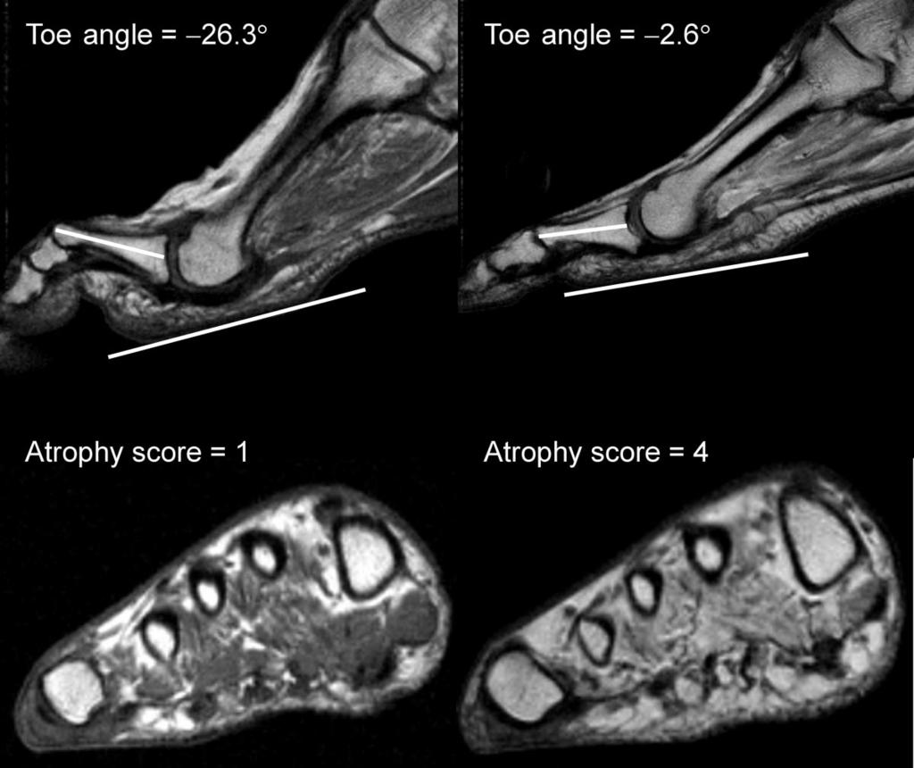 Intrinsic muscle atrophy and claw toe deformity Figure 2 Two cases illustrating the lack of association between intrinsic muscle atrophy and claw toe deformity.