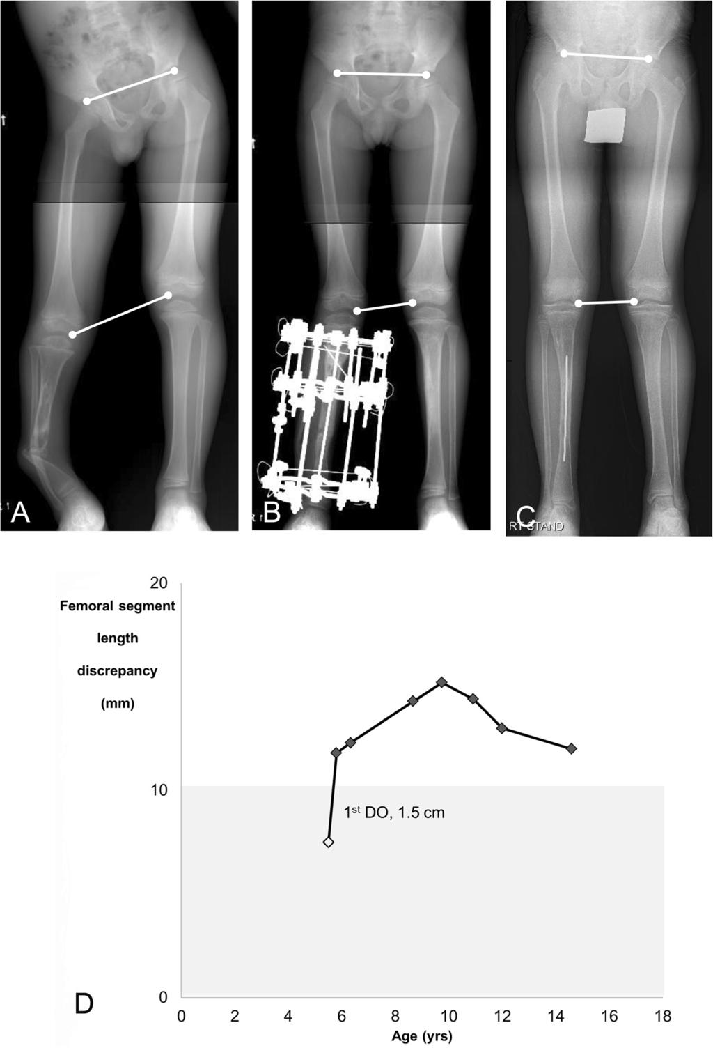 Song et al. BMC Musculoskeletal Disorders (2016) 17:274 Page 4 of 8 Fig. 1 An example of Type B femoral overgrowth in a 14.6-year-old boy (Patient 13).