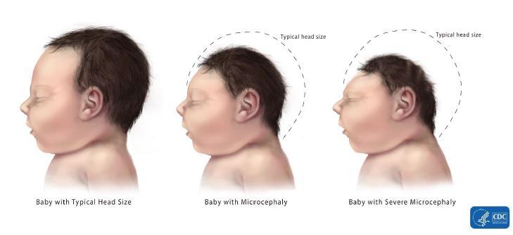 Range of Microcephaly Severity Severe: Need developmental services early in life (speech, occupational, physical therapy, potential
