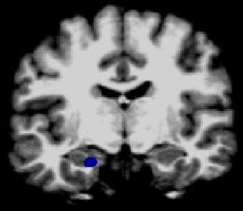 Amygdala less active Consistent with